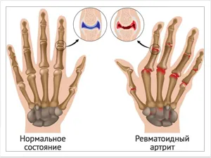 Пиявици при ревматоиден артрит, лечението с girudoterapii