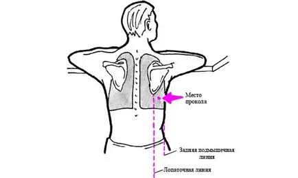 Пневмоторакс което означава, че причините, симптомите, лечението, спешна медицинска помощ, последствията, рехабилитация