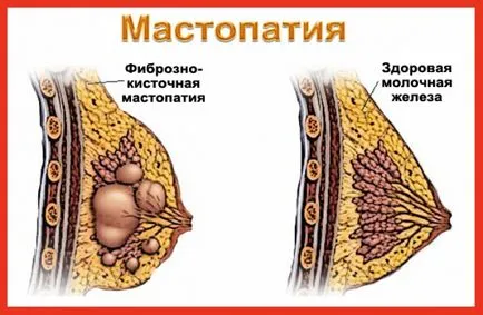 Защо болки в гърдите при жените причини, симптоми, лечение мастодиния и мастит през пролетта