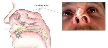 Полипоидни синузит причинява симптомите и лечението