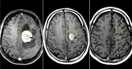 Felkészülés MRI az agy - ellenjavallatok, ajánlások, hogyan kell beolvasni