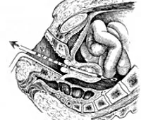 daune la nivelul uterului - cauze, simptome, diagnostic și tratament