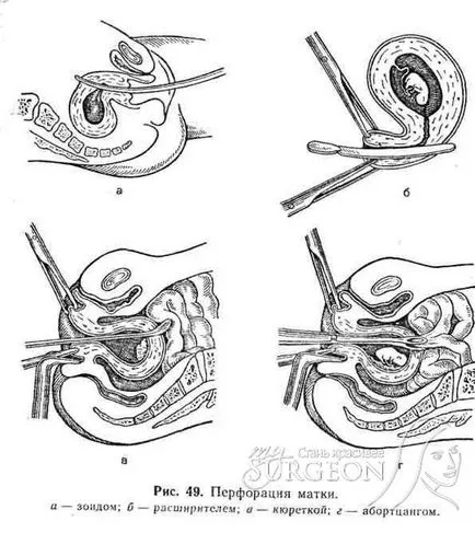 deteriorarea uterului (cervix si corp)