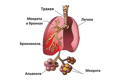 Признаци и симптоми на възпаление на белите дробове в един възрастен без треска