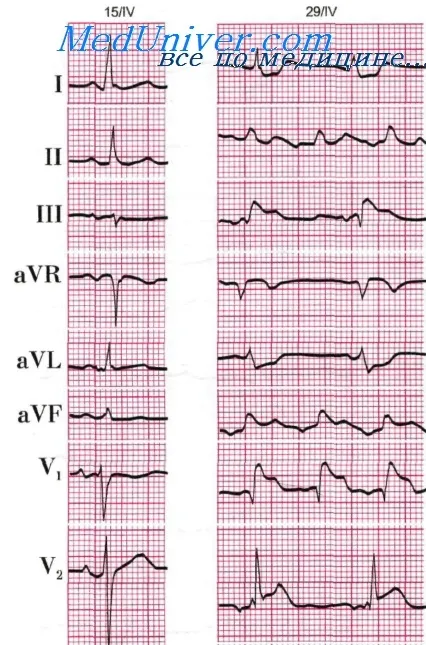 Példa EKG PE