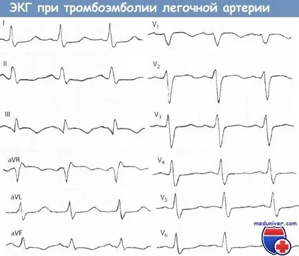 EXEMPLU ECG cu PE