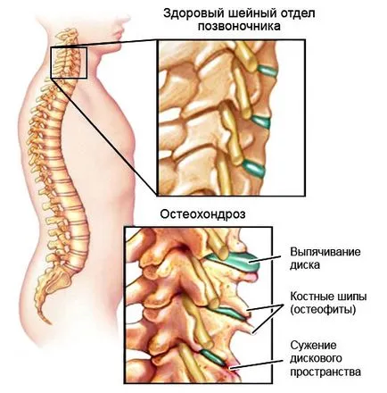 Noi folosim 9 tipuri de plante pentru tratamentul bolilor degenerative de disc de col uterin