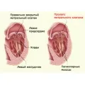 Пролапс на митралната клапа по време на бременност - причини, симптоми, управление на труда