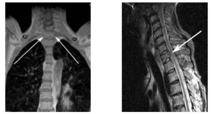 protetic tecorp corpului vertebral