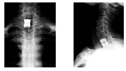 протезен гръбначния тяло tecorp