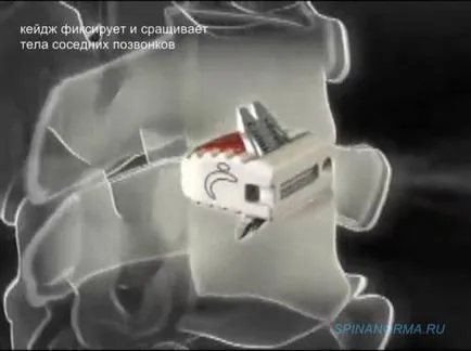 disc intervertebral protetică