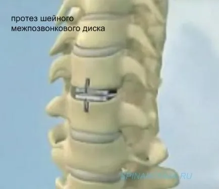 disc intervertebral protetică