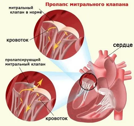 Митралната клапа симптоми пролапс и лечение по време на бременността