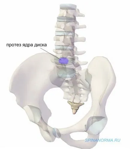 disc intervertebral protetică