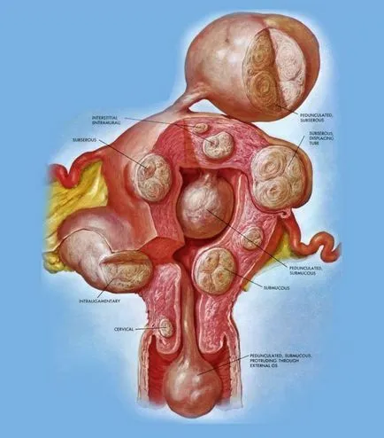 Sumar - fibrom uterin