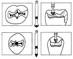 Instrumente de tăiere - Instrumente dentare - Chirurgie si tratament
