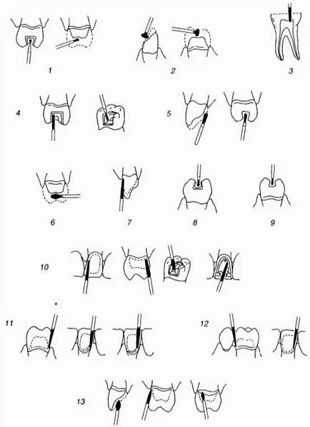 Instrumente de tăiere - Instrumente dentare - Chirurgie si tratament