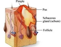 Sfaturi cosmetician masca acnee argila, fulgi de ovăz, bicarbonat de sodiu