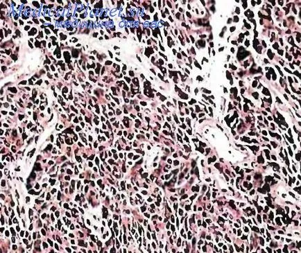 Papilláris pajzsmirigy adenoma sejtből
