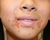 Streptoderma при децата предизвиква, симптоми и лечение в дома на детето по лицето