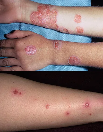 Streptoderma при децата предизвиква, симптоми и лечение в дома на детето по лицето