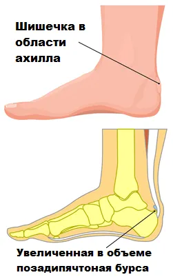 Tendinosis ахилесово сухожилие