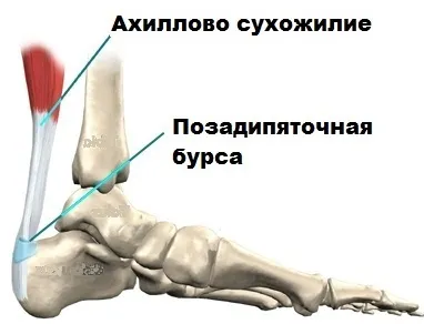 Tendinosis ахилесово сухожилие