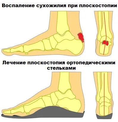 Tendinosis ахилесово сухожилие