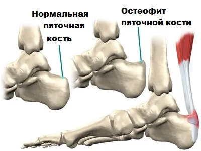 Tendinosis ахилесово сухожилие