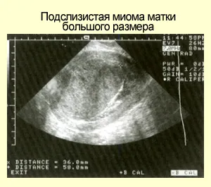 Ултразвукова диагностика на миома на матката
