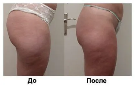 Liposuctia cu ultrasunete - Ce este, comentarii, fotografii înainte și după, prețuri, contraindicații