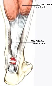 Uzi lui Ahile ultrasunete tendon pentru toată lumea!