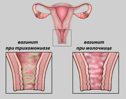 simptome vaginită și tratament