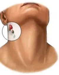 Epstein-Barr vírus vagy fertőző mononucleosis