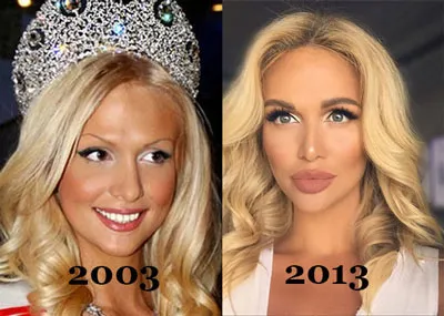 fotografii Victoria Lopyreva înainte și după plastic