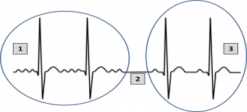 Recuperarea ritmului cardiac cardioversie electrice, defibrilare g