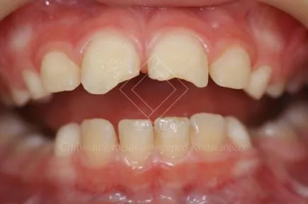 Restaurare dintii din fata - chipped medici dentare Kopylova