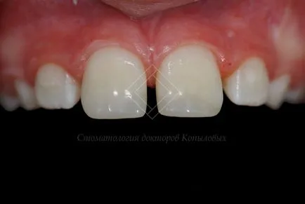 Restaurare dintii din fata - chipped medici dentare Kopylova