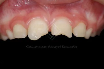 Възстановяване бичен предни зъби - Дентални лекари Kopylova