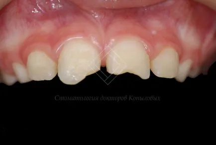 Restaurare dintii din fata - chipped medici dentare Kopylova