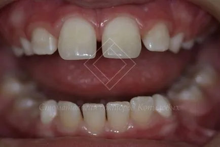 Restaurare dintii din fata - chipped medici dentare Kopylova