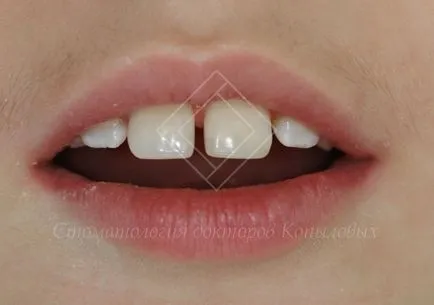 Restaurare dintii din fata - chipped medici dentare Kopylova