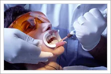 Химически избелване на зъби цена