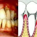 dacă boala parodontală este contagioasă, stomatologie