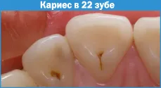 plombele dentare