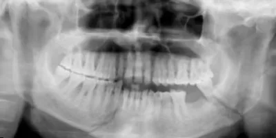 Dinți atele o fractură a maxilarului inferior imagini, simptome, tratament