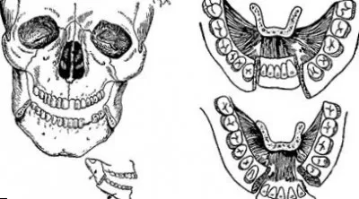 Dinți atele o fractură a maxilarului inferior imagini, simptome, tratament