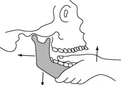 Dinți atele o fractură a maxilarului inferior imagini, simptome, tratament