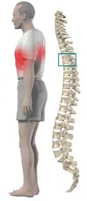 Osteocondrozei a coloanei vertebrale toracice cauze, simptome, tratament