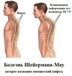 osteohondropatija гръбнака причинява, диагностика и лечение